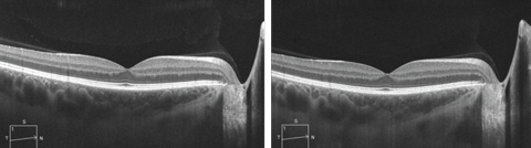 SD-OCT line scan with (at left) and without enhanced depth imaging, which allows for  visualization of the choroidal layers and the choroid-scleral interface.