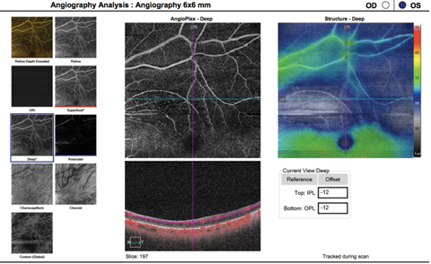 This OCT-A image (6mm by 6mm) shows a patient with a previous branch retinal artery occlusion, as indicated by the well-demarcated area of flow interruption in both superficial and deep vascular capillary plexuses visible on the scan.