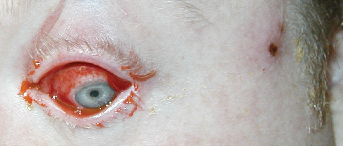 Fig. 3. This patient with culture-positive HSV keratoconjunctivitis of the left eye (note herpetic lesions on temple) was treated with oral antiviral therapy and received a narcotic for pain.