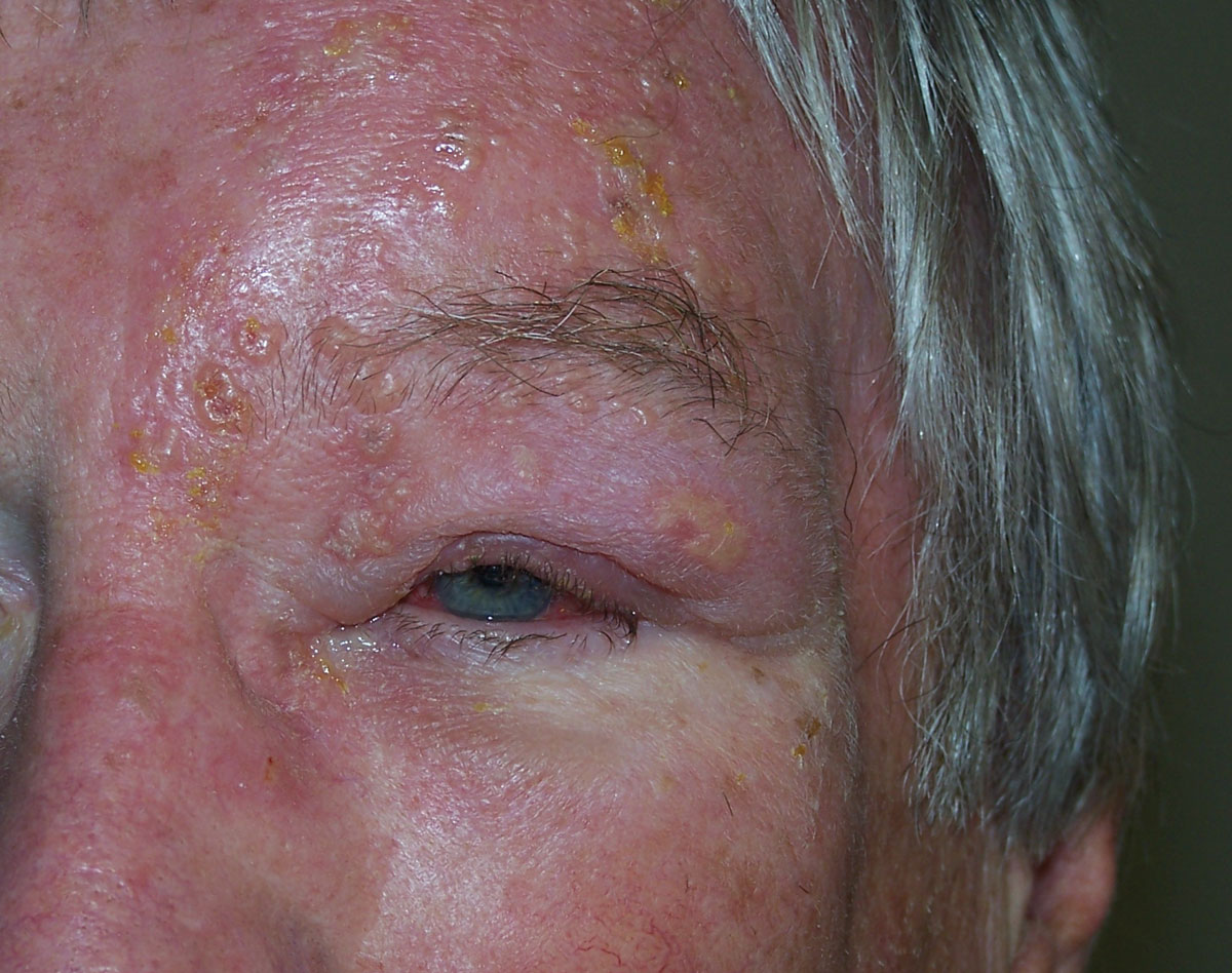 Fig. 4. This patient with herpes zoster ophthalmicus was successfully managed with an antiviral therapy.
