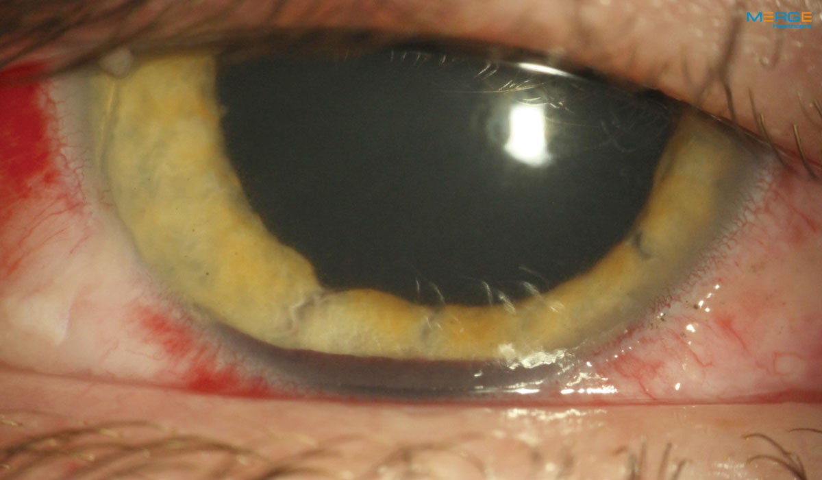 Fig. 7. This patient who had blunt trauma with hyphema, corneal and conjunctival abrasions, anterior uveitis and iris sphincter tears received an adjunctive oral narcotic for three days.