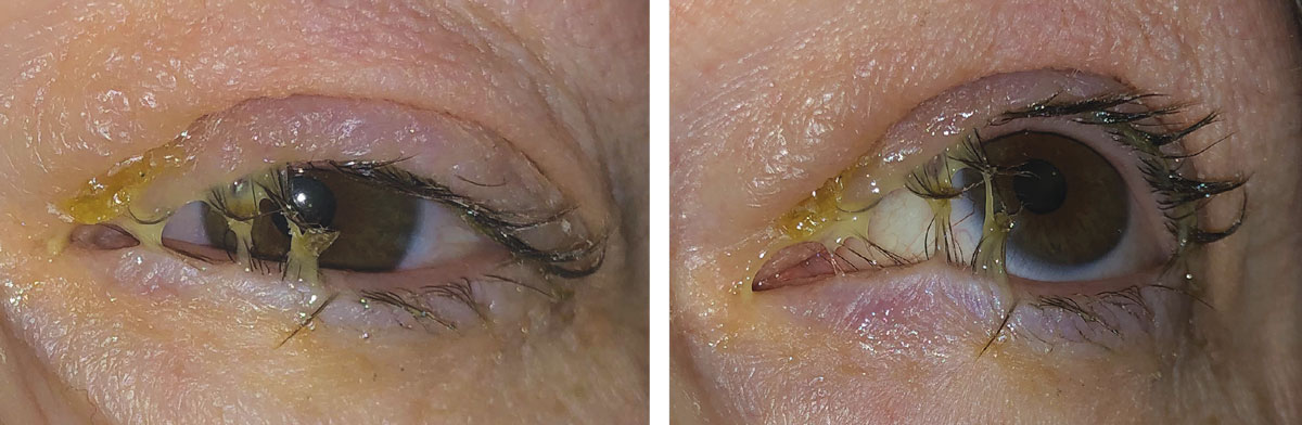 This patient presented with a typical acute bacterial conjunctivitis. Empirically treating for a bacteria rather than a virus would be the optimal choice due to the purulent exudate. A topical antibiotic would be an acceptable treatment option. Appropriate topical choices include polymyxin B + trimethoprim, a fluoroquinolone (ciprofloxacin, ofloxacin) or tobramycin.1-4 If this patient has a penicillin or sulfa allergy, all of these agents would still be appropriate. If the patient is pregnant or breastfeeding, all of these agents would still be appropriate due to little/no systemic absorption. 