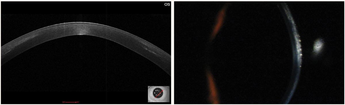 Fig. 5. Patient one month post-CXL with anterior corneal haze. Note the demarcation/hyperreflective line on OCT.