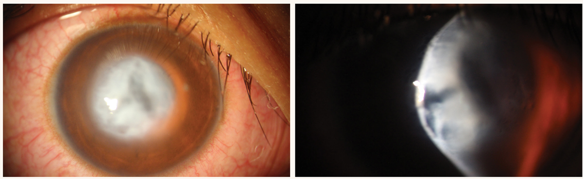 Fig. 6. Acute corneal hydrops in a patient with severe keratoconus.