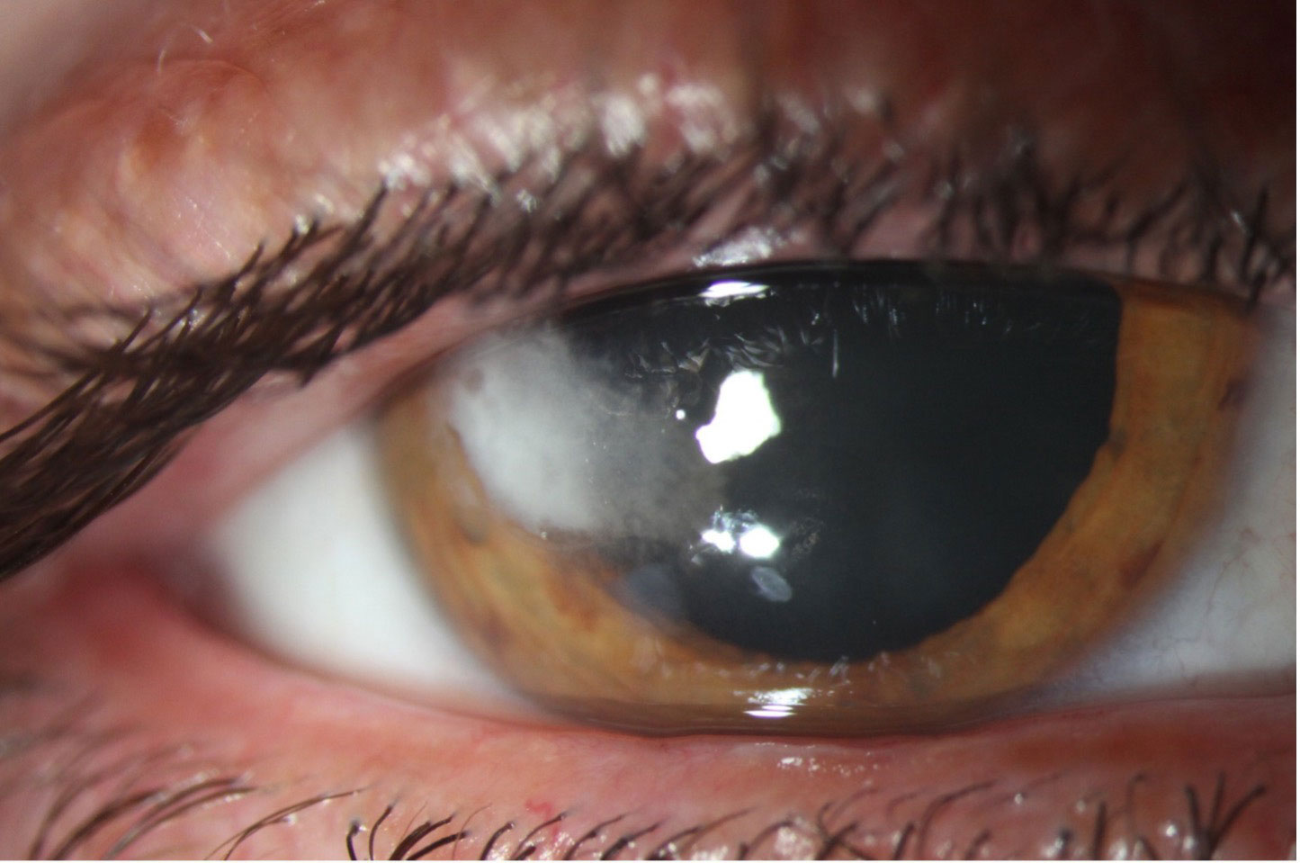 This patient presented with a history of recent ocular trauma. He denied significant pain but eventually sought eye care due to blurred vision. Despite the relative “quiet” appearance of his eye, the corneal culture revealed Fusarium species.