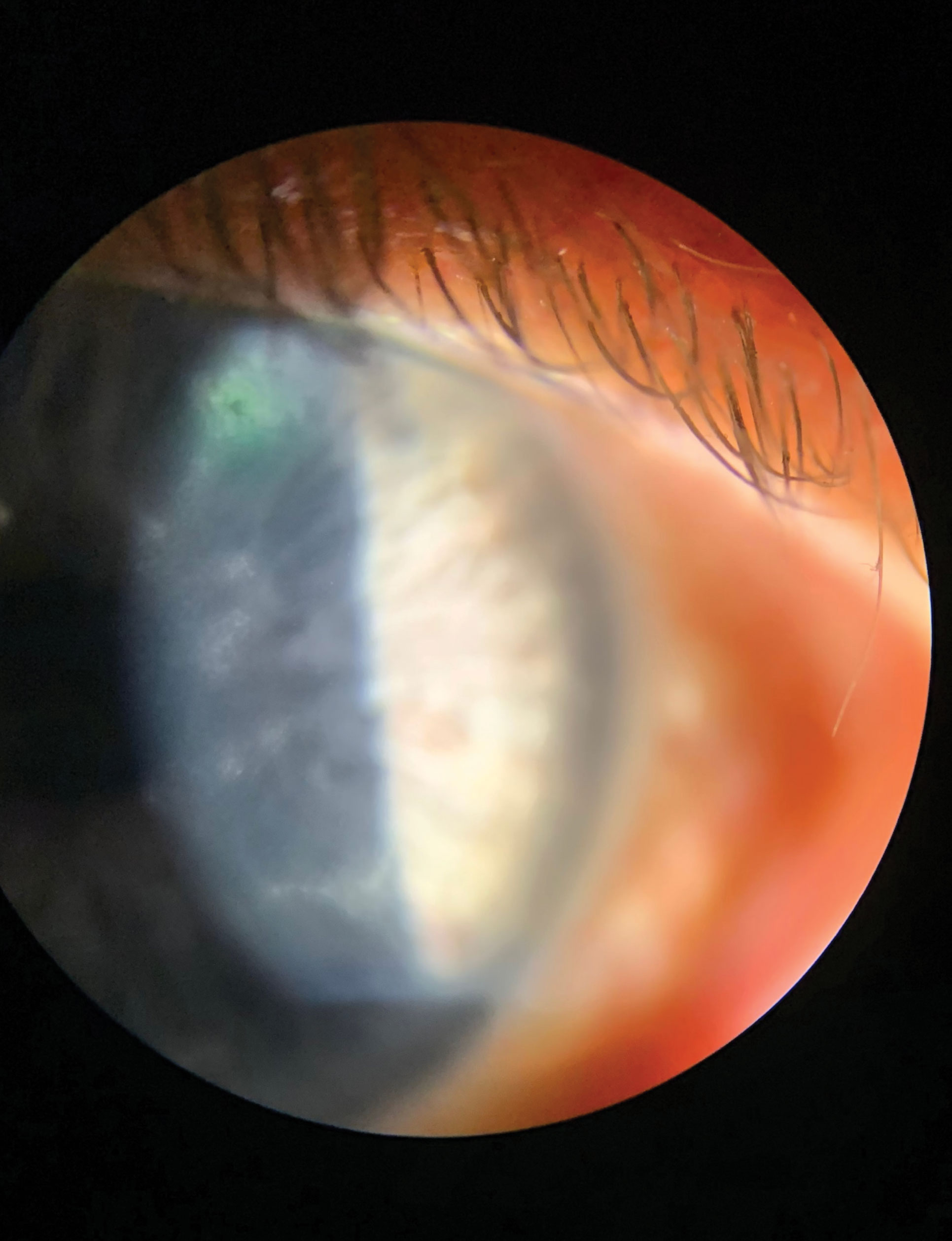 HSV stromal keratitis with or without ulceration can be focal, multifocal or diffuse. This patient has HSV stromal keratitis with epithelial involvement.