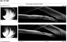 Figs. 4 and 5. Angle OCT shows a 20 degree angle OD and a 15 degree OS.