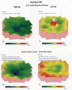 Fig. 4. What information about the macula’s health can be gleaned from these multifocal ERG graphics of the right and left eyes?