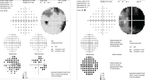 Figs. 3. Our patient’s visual field test results at initial clinical presentation. Note the findings in the left eye (at right).