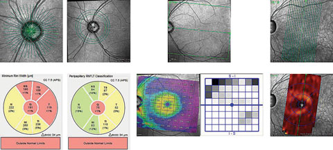 These OCT images show radial scanning of the optic nerve and identify the edge of Bruch’s membrane. High resolution of Bruch’s membrane opening gives us a true picture of the actual optic canal, and subsequent measurements of the rim with in these areas is precise and repeatable.