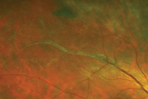 Here, venous sheathing was caused by early periphlebitis as seen in sarcoid uveitis. The vasculitis in these cases may become occlusive and lead to BRVO.