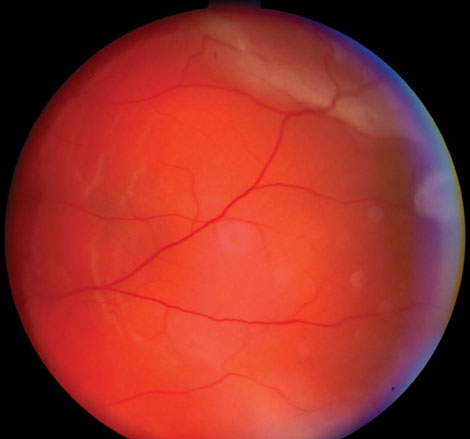 This 57-year-old male’s retinal detachment occurred seven months after cataract surgery in his left eye.