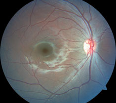 Do these fundus photographs provide any explanation for our patient’s blurred vision?