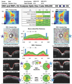 Fig. 1. OCT peripapillary RNFL scan depicting temporal quadrant thinning OU compared with normative data.