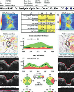 SD-OCT ONH and RNFL analysis in a patient with early POAG.