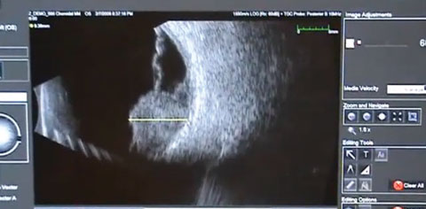 Software that accompanies ultrasound devices—such as the caliper tools being employed here—can measure any lesions discovered. 