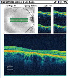 SD-OCT images show the patient’s retinal state in both the right and left eye.