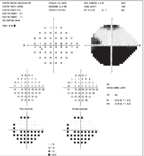 This visual field depicts an ischemic optic neuropathy of the left eye.