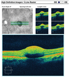 Can these fundus photos and OCT images help explain our 39-year-old patient’s worsening vision blur? What can his systemic changes tell you about his diagnosis?