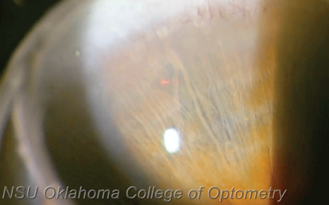 The clinician prepares to fire the first shot. Before beginning the procedure, we put Alphagan (brimonidine tartrate, Allergan) and pilocarpine in the eye