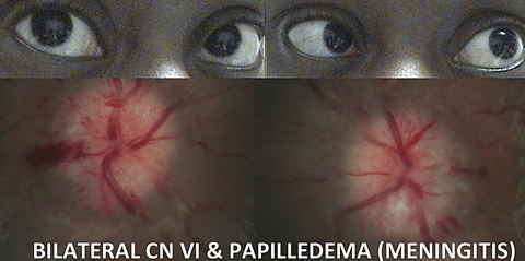 In cases of CN VI, always assess the optic discs for features of even subtle papilledema, since this constitutes a medical emergency.