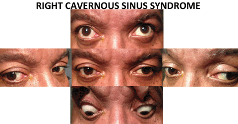 The combination of a right CN III pattern as well as a right abduction deficit, localizes the lesion to the cavernous sinus.