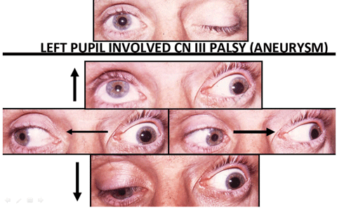 Evidence of pupil-involved CN III palsy requires an emergent work up, due to the risk of mortality associated with aneurysm.