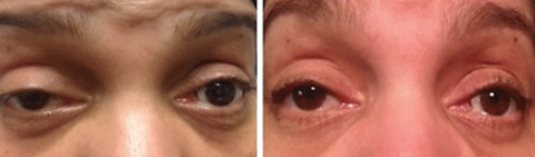 To perform ice pack testing, hold ice on the eyelids for two minutes