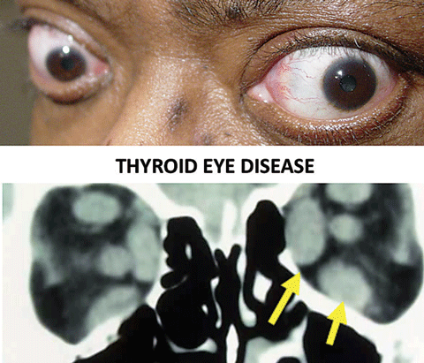 Thyroid eye disease is the most common cause of ocular motility restrictions in adults.