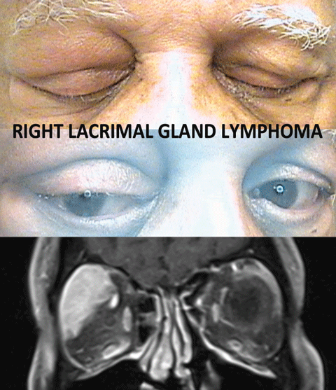 The MRI demonstrates a well-defined soft-tissue mass affecting, but not destroying, surrounding tissue. 