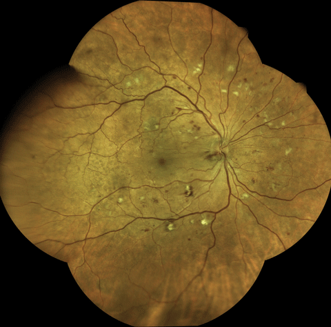 Using an Eidon True Color Confocal Scanner, this image shows moderate to severe NPDR with multiple cotton-wool spot and dot/blot hemorrhages.