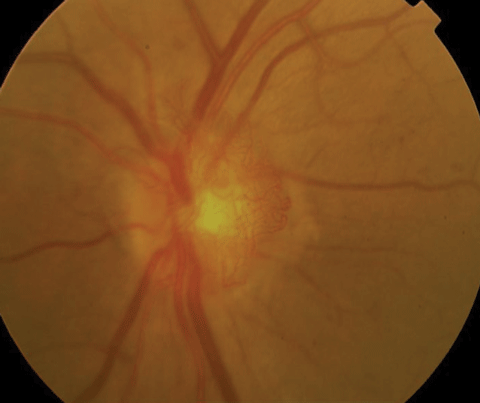 High-risk PDR with significant NVD greater than 1/3DD.