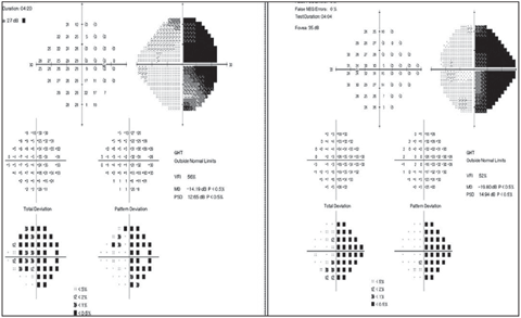 Humphrey visual field revealed right homonymous hemianopia.