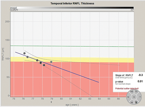 Inferotemporal Garway-Heath optic nerve sector RNFL data over time. Note the significant decline in the RNFL thickness in this one optic nerve sector, implying a rather significant progression.