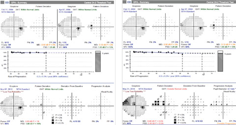 For case one, at the time that progression of the inferior RNFL loss was confirmed, the most recent visual field, left, showed no progression. However, over the next three years, she developed a corresponding superior visual field defect, right.