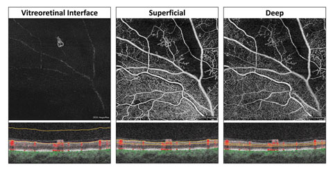 These three en face OCT-A images are displayed with their corresponding segmentation boundaries below.