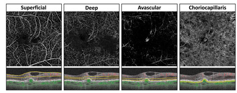 This en face OCT-A with corresponding segmentation boundaries shows an eye with exudative AMD and retinal angiomatous proliferation.