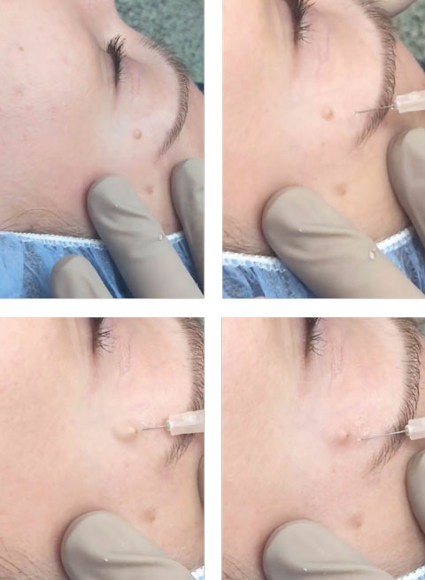 Top left, keep the skin taut immediately before and during the injection. Top right, note the approximately 10- to 20-degree angle of the 30g needle above the skin plane. Bottom left, as the doctor performs the intradermal injection, note the bolus of anesthetic underneath the lesion. Bottom right, the anesthetic is placed underneath the lesion.