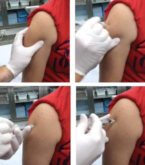 Top left, pinching the muscle can help allow easy access for the medication. Top right, as the needle enters the skin for an IM injection, note how the maneuvering is similar to that of throwing a dart. Bottom left, the doctor pulls back on the plunger just before injection to ensure the needle is not in a blood vessel. Bottom right, the medication is injected at a slow and steady rate.