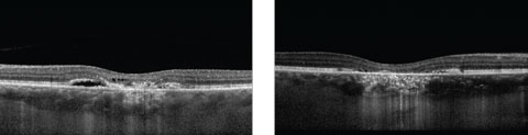 Figs. 1a and 1b. These two OCT images show two stages of the patient’s condition. Can you make the diagnosis? 