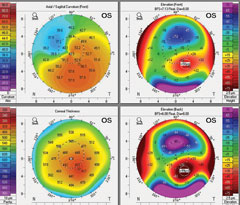 A patient’s baseline tomography. 