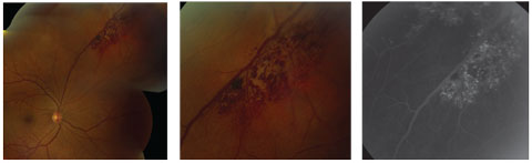 This cavernous hemangioma demonstrates the classic “cluster of grapes” distribution. At right, the corresponding fluorescein angiography demonstrates the persistent hyperfluorescence in the late phase.