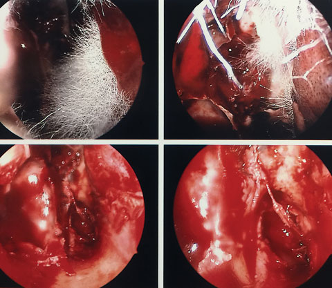 These nasal sinus endoscopy images show mucorales hyphae.