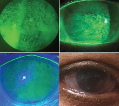 Fig. 2. These epithelial staining examples all merit the use of an amniotic membrane (bottom right).