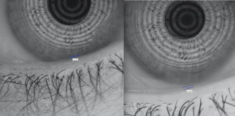 Fig. 6. Punctal plugs can double the tear meniscus height, as seen here.