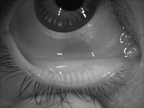 Fig. 3. Meibography shows more than 50% meibomian gland atrophy of the lower lid.