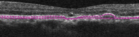 This structural OCT image of the same eye shows RPE elevations and mild foveal subretinal fluid.