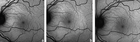 Fig. 6. Serial FAF photos of the left eye at (a) initial presentation, (b) first follow-up, and (c) second follow-up. Note the extension of the hyperfluorescence inferior to the optic nerve and macula in (b) and resolution of hyperfluorescence in (c). These findings were consistent with the changes in the PIL shown in Figure 5.