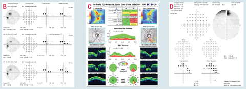 This 76-year-old patient has early-moderate primary open-angle glaucoma in the left eye and is a high-risk glaucoma suspect in the right. His IOPs were stable with current topical ocular hypotensive medications. Gonioscopy was normal OU and pachymetry measurements were thinner than average, 504μm OD and 508μm OS. Despite limited commitment to follow-up, his most recent 24-2 for his left eye (B) confirmed overall stable superior paracentral defects, which were consistent with inferior neuroretinal rim thinning and moderate inferior/inferior-temporal RNFL loss on OCT testing (C). The patient’s current 24-2 test pattern isn’t sufficient to fully understand his level of visual impairment and reliably monitor for glaucomatous progression. Central 10-2 testing (D), however, can help reveal the risk of potential visual impairment and better monitor for disease progression.