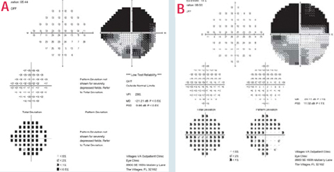 This patient’s 24-2 VF testing shows apparent advanced structural and functional glaucomatous damage with diffuse and deep superior central and paracentral damage (A). Such testing alone can lead clinicians to not only underestimate the extent of glaucomatous VF damage, but also overestimate the extent of damage and potentially miss the area of remaining superior temporal paracentral sensitivity (B).